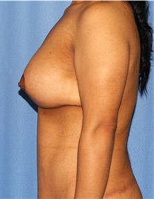 Breast Augmentation After Photo by Siamak Agha, MD PhD FACS; Newport Beach, CA - Case 46720