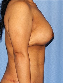 Breast Augmentation After Photo by Siamak Agha, MD PhD FACS; Newport Beach, CA - Case 46720