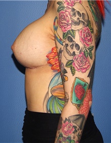 Breast Augmentation After Photo by Siamak Agha, MD PhD FACS; Newport Beach, CA - Case 46722