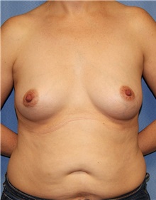 Breast Augmentation Before Photo by Siamak Agha, MD PhD FACS; Newport Beach, CA - Case 46723