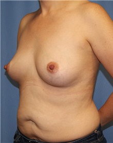 Breast Augmentation Before Photo by Siamak Agha, MD PhD FACS; Newport Beach, CA - Case 46723