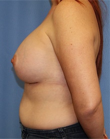 Breast Augmentation After Photo by Siamak Agha, MD PhD FACS; Newport Beach, CA - Case 46723