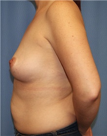 Breast Augmentation Before Photo by Siamak Agha, MD PhD FACS; Newport Beach, CA - Case 46723