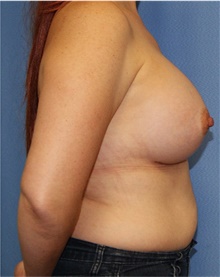 Breast Augmentation After Photo by Siamak Agha, MD PhD FACS; Newport Beach, CA - Case 46723