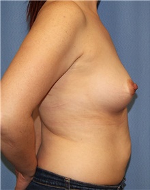 Breast Augmentation Before Photo by Siamak Agha, MD PhD FACS; Newport Beach, CA - Case 46723