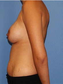 Breast Augmentation After Photo by Siamak Agha, MD PhD FACS; Newport Beach, CA - Case 46724