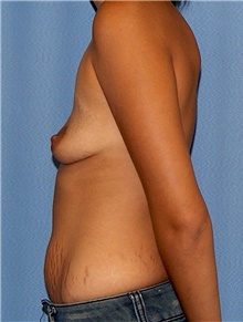 Breast Augmentation Before Photo by Siamak Agha, MD PhD FACS; Newport Beach, CA - Case 46724