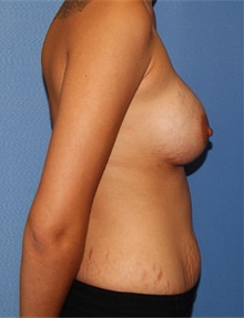 Breast Augmentation After Photo by Siamak Agha, MD PhD FACS; Newport Beach, CA - Case 46724
