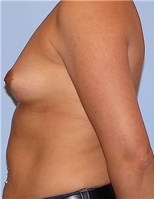 Breast Augmentation Before Photo by Siamak Agha, MD PhD FACS; Newport Beach, CA - Case 46725