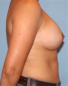 Breast Augmentation After Photo by Siamak Agha, MD PhD FACS; Newport Beach, CA - Case 46725
