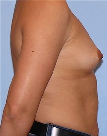 Breast Augmentation Before Photo by Siamak Agha, MD PhD FACS; Newport Beach, CA - Case 46725