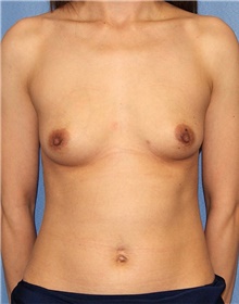 Breast Augmentation Before Photo by Siamak Agha, MD PhD FACS; Newport Beach, CA - Case 46726