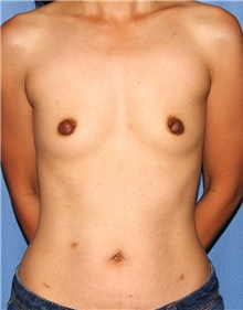 Breast Augmentation Before Photo by Siamak Agha, MD PhD FACS; Newport Beach, CA - Case 46731