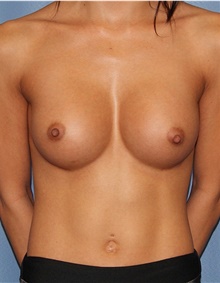 Breast Augmentation After Photo by Siamak Agha, MD PhD FACS; Newport Beach, CA - Case 46732