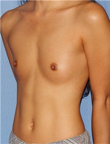 Breast Augmentation Before Photo by Siamak Agha, MD PhD FACS; Newport Beach, CA - Case 46732