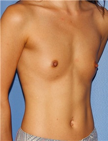 Breast Augmentation Before Photo by Siamak Agha, MD PhD FACS; Newport Beach, CA - Case 46732