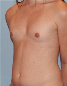 Breast Augmentation Before Photo by Siamak Agha, MD PhD FACS; Newport Beach, CA - Case 46734