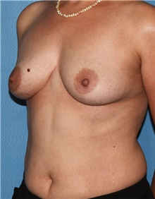 Breast Augmentation Before Photo by Siamak Agha, MD PhD FACS; Newport Beach, CA - Case 46735
