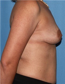 Breast Augmentation Before Photo by Siamak Agha, MD PhD FACS; Newport Beach, CA - Case 46735