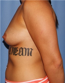 Breast Augmentation Before Photo by Siamak Agha, MD PhD FACS; Newport Beach, CA - Case 46736