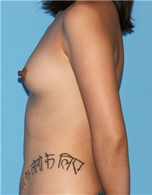 Breast Augmentation Before Photo by Siamak Agha, MD PhD FACS; Newport Beach, CA - Case 46737