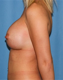 Breast Augmentation After Photo by Siamak Agha, MD PhD FACS; Newport Beach, CA - Case 46738