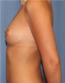Breast Augmentation Before Photo by Siamak Agha, MD PhD FACS; Newport Beach, CA - Case 46738