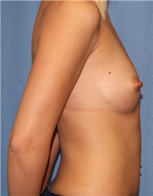 Breast Augmentation Before Photo by Siamak Agha, MD PhD FACS; Newport Beach, CA - Case 46738