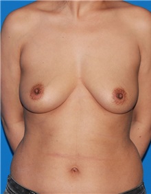 Breast Augmentation Before Photo by Siamak Agha, MD PhD FACS; Newport Beach, CA - Case 46739