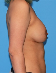Breast Augmentation After Photo by Siamak Agha, MD PhD FACS; Newport Beach, CA - Case 46739