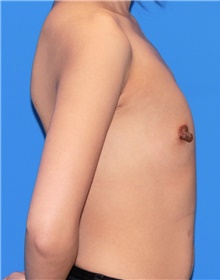 Breast Augmentation Before Photo by Siamak Agha, MD PhD FACS; Newport Beach, CA - Case 46740