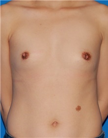 Breast Augmentation Before Photo by Siamak Agha, MD PhD FACS; Newport Beach, CA - Case 46741