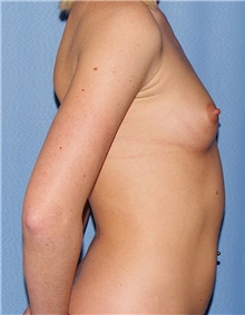 Breast Augmentation Before Photo by Siamak Agha, MD PhD FACS; Newport Beach, CA - Case 46742