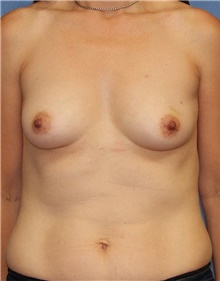 Breast Augmentation Before Photo by Siamak Agha, MD PhD FACS; Newport Beach, CA - Case 46743