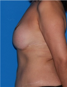 Breast Implant Revision Before Photo by Siamak Agha, MD PhD FACS; Newport Beach, CA - Case 46745
