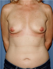 Breast Augmentation Before Photo by Siamak Agha, MD PhD FACS; Newport Beach, CA - Case 46747