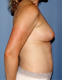 Breast Augmentation After Photo by Siamak Agha, MD PhD FACS; Newport Beach, CA - Case 46747