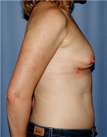 Breast Augmentation Before Photo by Siamak Agha, MD PhD FACS; Newport Beach, CA - Case 46747