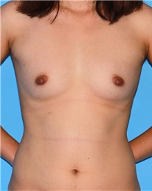 Breast Augmentation Before Photo by Siamak Agha, MD PhD FACS; Newport Beach, CA - Case 46748