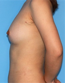 Breast Augmentation After Photo by Siamak Agha, MD PhD FACS; Newport Beach, CA - Case 46748