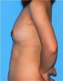 Breast Augmentation Before Photo by Siamak Agha, MD PhD FACS; Newport Beach, CA - Case 46748