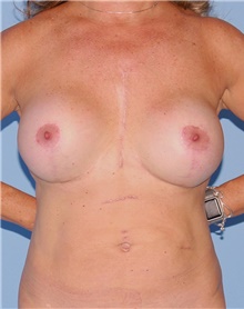 Tummy Tuck Before Photo by Siamak Agha, MD PhD FACS; Newport Beach, CA - Case 46763