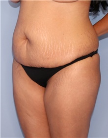 Tummy Tuck Before Photo by Siamak Agha, MD PhD FACS; Newport Beach, CA - Case 46764