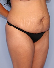 Tummy Tuck Before Photo by Siamak Agha, MD PhD FACS; Newport Beach, CA - Case 46764