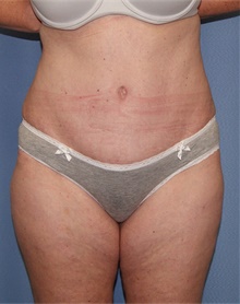 Tummy Tuck After Photo by Siamak Agha, MD PhD FACS; Newport Beach, CA - Case 46765