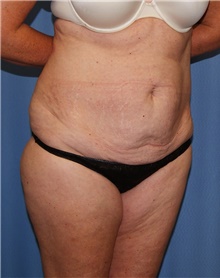 Tummy Tuck Before Photo by Siamak Agha, MD PhD FACS; Newport Beach, CA - Case 46765