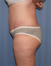 Tummy Tuck After Photo by Siamak Agha, MD PhD FACS; Newport Beach, CA - Case 46765