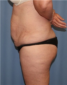 Tummy Tuck Before Photo by Siamak Agha, MD PhD FACS; Newport Beach, CA - Case 46765