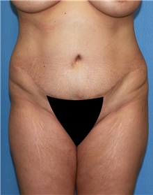 Tummy Tuck Before Photo by Siamak Agha, MD PhD FACS; Newport Beach, CA - Case 46766