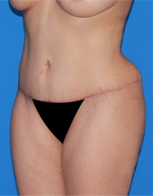 Tummy Tuck After Photo by Siamak Agha, MD PhD FACS; Newport Beach, CA - Case 46766
